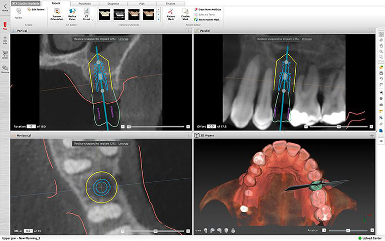 Computer Assisted Implant Planning xrays
